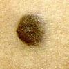 fibromi