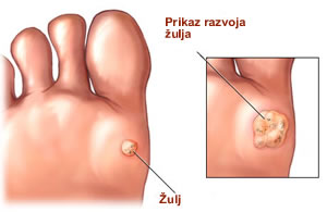 Žulji na stopalu